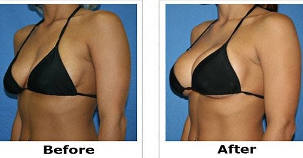 Best-Ways-to-Increase-Breast-Size-without-Surgery